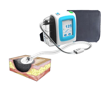 машина для лечения ран с отрицательным давлением с дренажной канистрой 140 мл/450 мл и 10 комплектами медицинского перевязочного комплекта NPWT разного размера